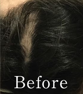 50代女性 発毛施術ビフォー