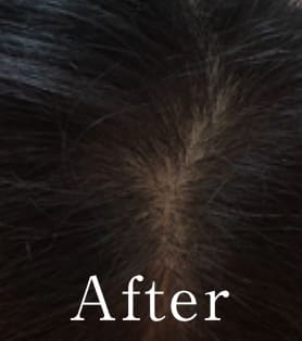 60代女性 発毛施術アフター