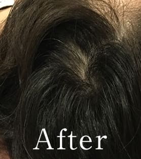 50代女性 発毛施術アフター