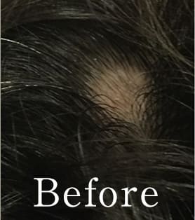 50代女性 発毛施術ビフォー