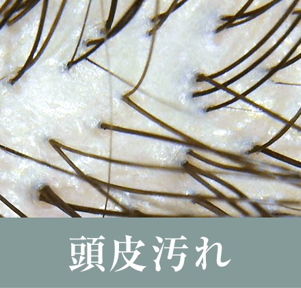 頭皮汚れ